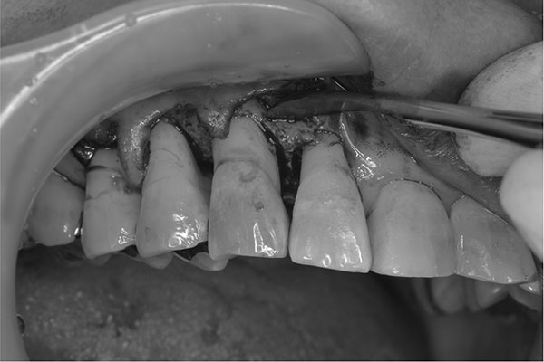 歯周外科手術の写真
