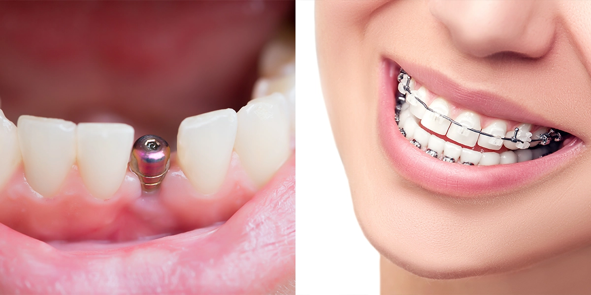 治療順序の考え方 矯正が先か、インプラントが先か