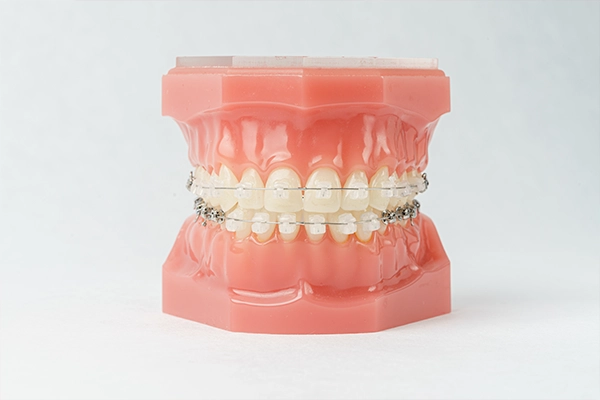 矯正治療（歯を動かす期間）