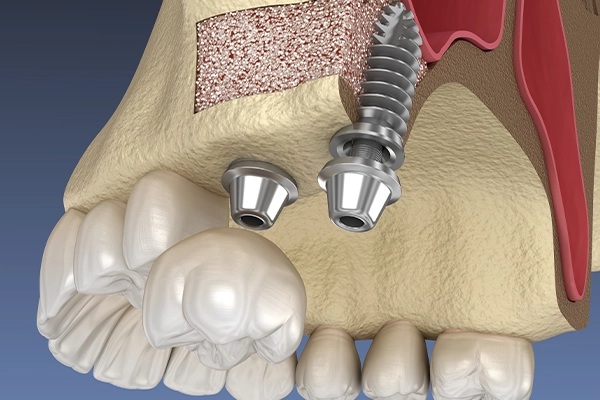 骨との結合期間