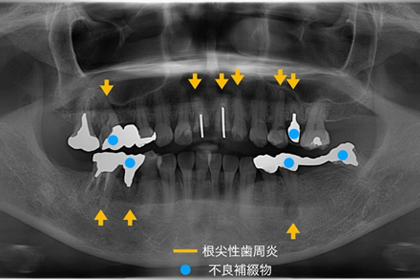 レントゲン写真