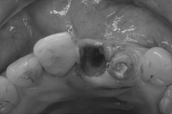 リッジプリザベーションの様子