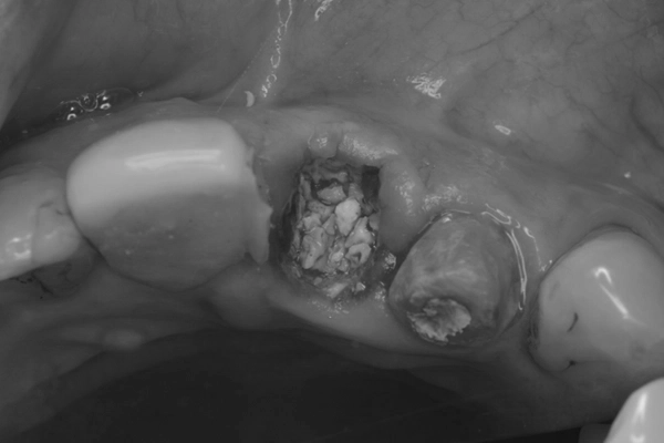 待時埋入の様子