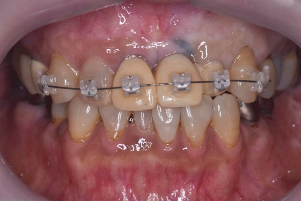 矯正治療の様子
