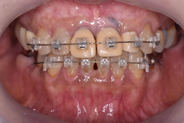 矯正治療の様子