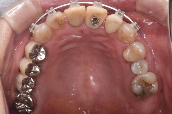 矯正治療の様子