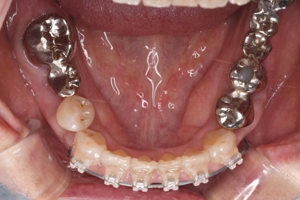 矯正治療の様子