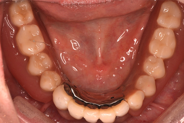 入れ歯装着後