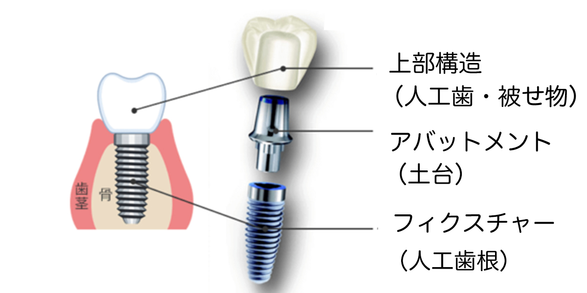 インプラントの構造