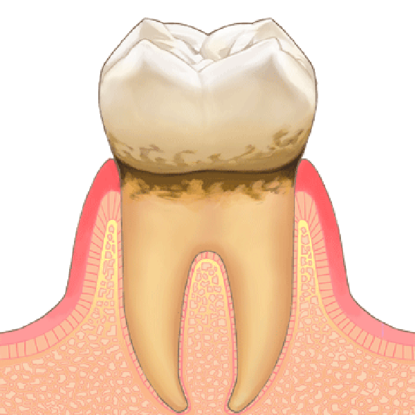 歯肉炎