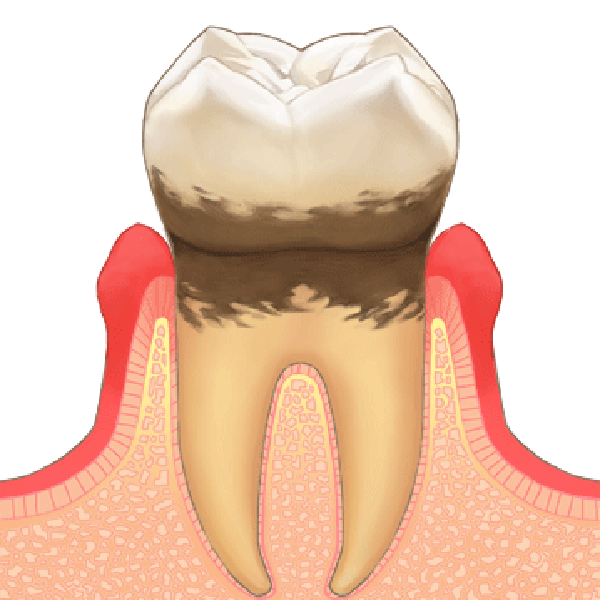 歯周病の初期