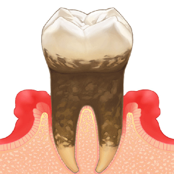 歯周病の中期