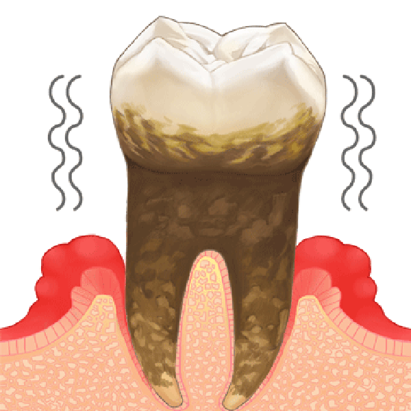 歯周病の重度期